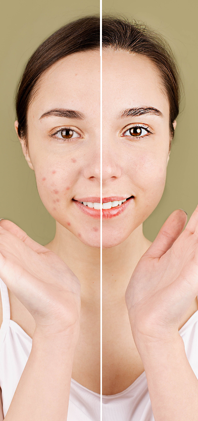 acne behandeling Ninove